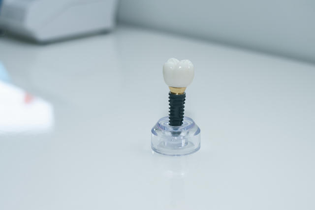 Are Dental Implants Painful? Pain Levels, Recovery & What to Expect? banner